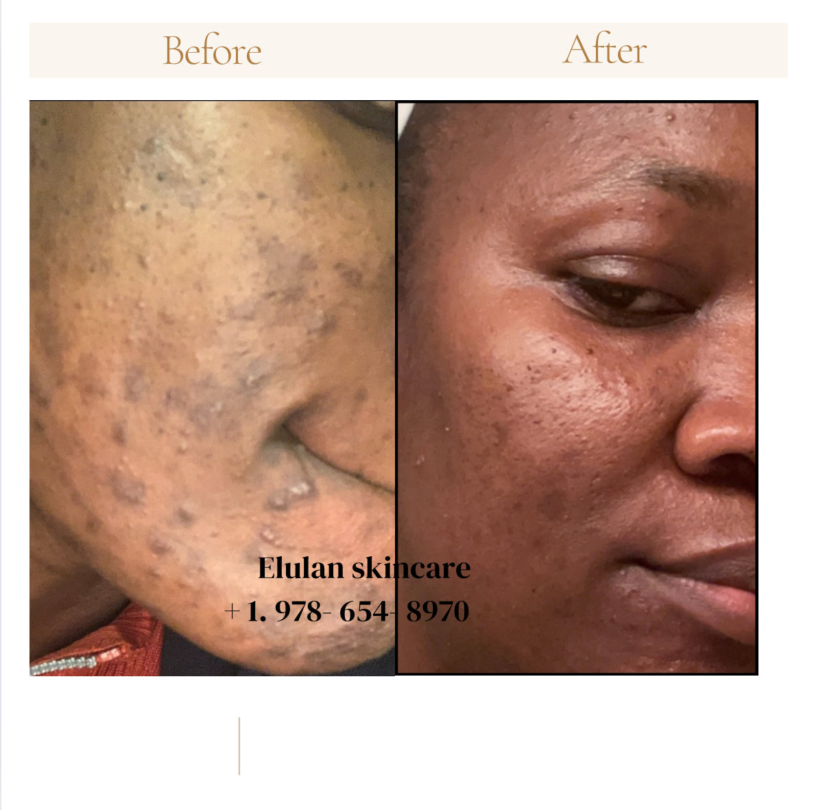 Turmeric Face Cleanser for Acne and Hyperpigmention