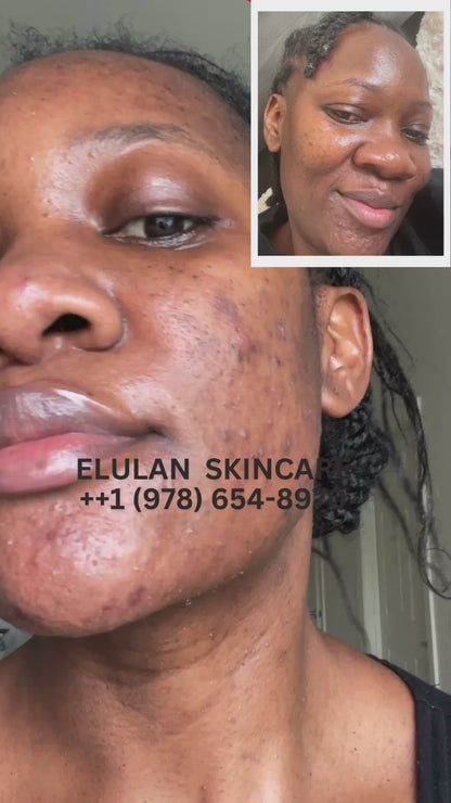 Acne and Hyperpigmentation Bundle